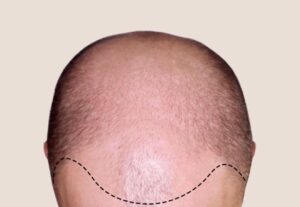 Antes de Mesoterapia Capilar