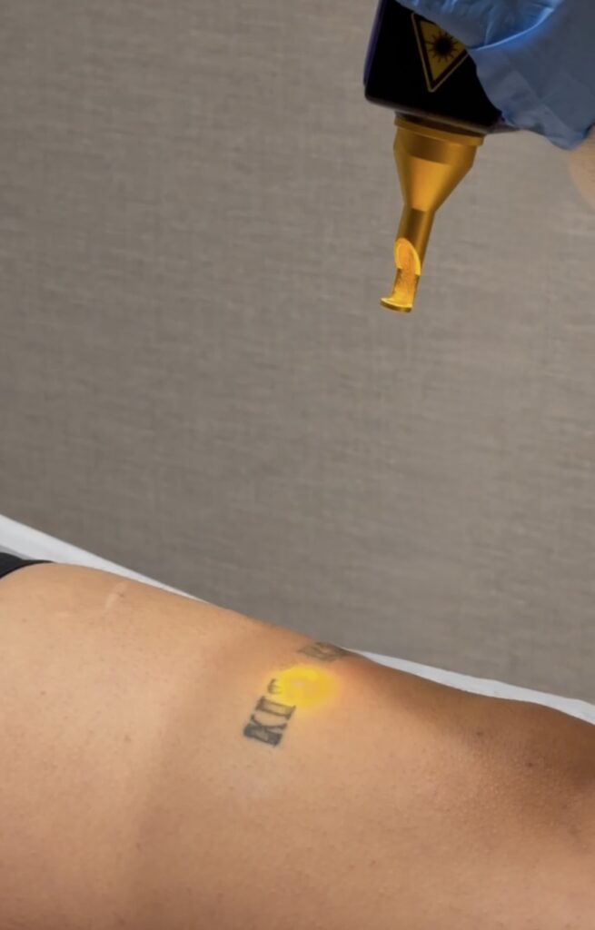 Tattoo removal: advanced laser technology that does not damage your skin