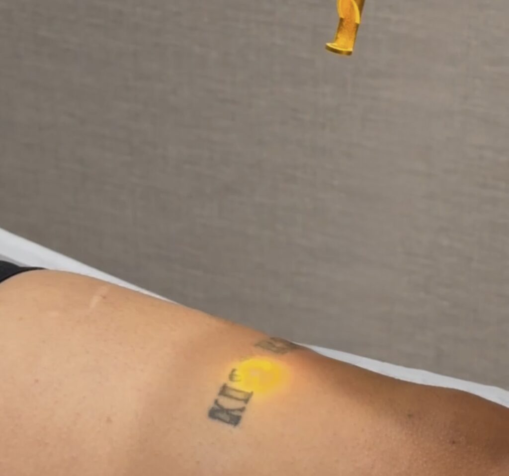 Elimina tu tatuaje de forma progresiva y segura